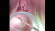 Video porn 2023 Hegar sound probing deep in cervix HD online