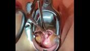 Video sex new Sound tenaculum applying traction to cervix online - xTeenPorn.Net