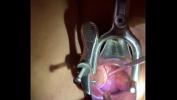 Free download video sex Insertion of sound tenaculum into cervix online