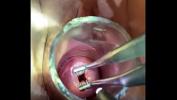 Video porn 2022 Bakes dilator enters through endocervical speculum in xTeenPorn.Net